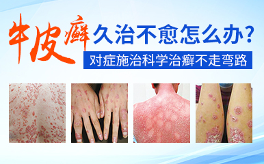 患了牛皮癣能治好吗 盘点牛皮癣的三个疗法