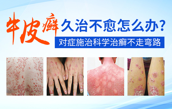 头部牛皮癣和头癣怎么区分
